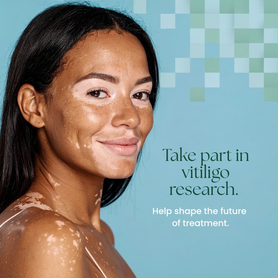 Vitiligo Study